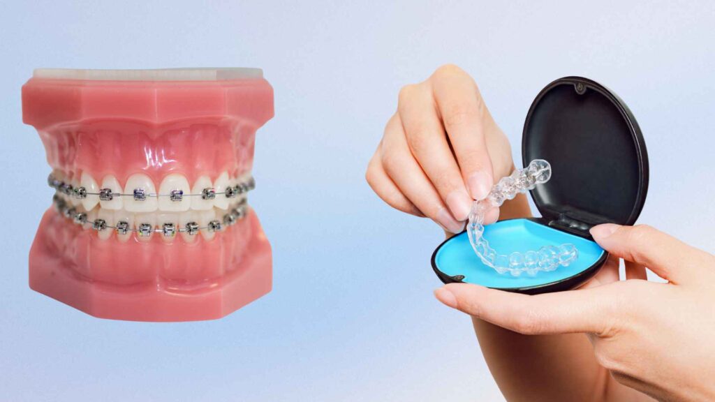 No More "Brace Face": Why Young Adults in Dhaka Are Switching to Clear Aligners