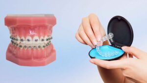 No More “Brace Face”: Why Young Adults in Dhaka Are Switching to Clear Aligners